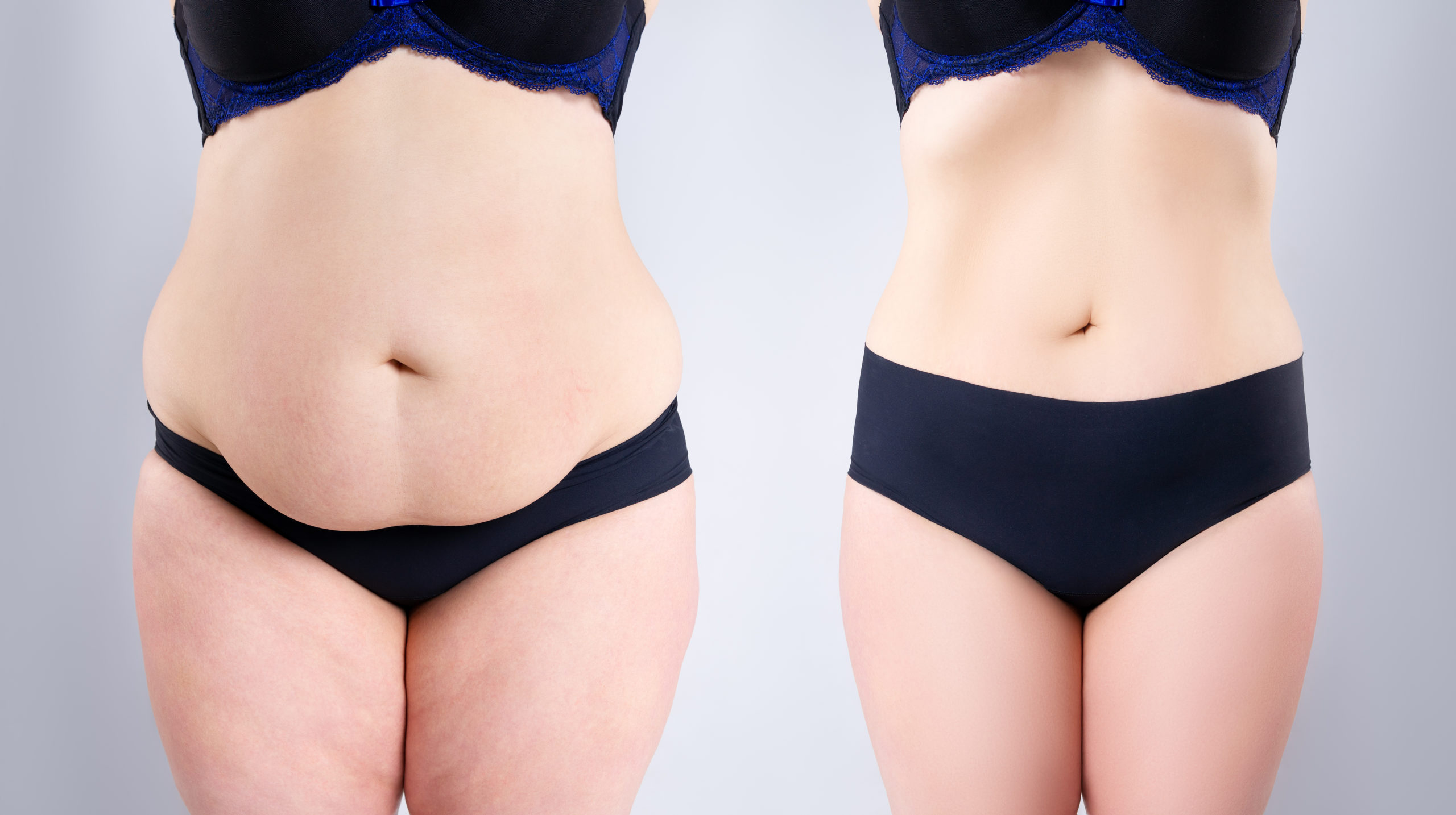 What Are the Side Effects of Tummy Tuck Surgery?