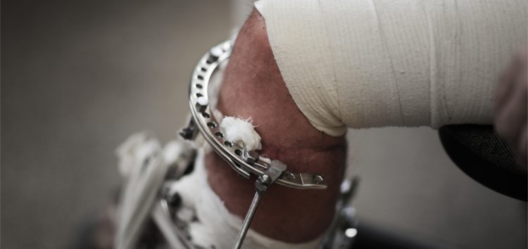 A broken knee held in a metal cage