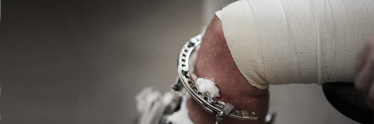Broken knee held in a metal cage
