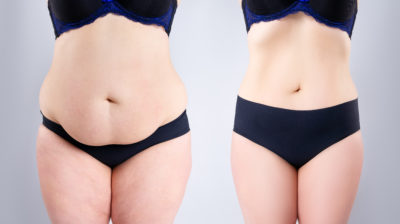 Tummy tuck gone wrong? - Blackwater Law