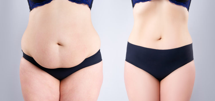 Woman's belly before and after weight loss on gray background, plastic surgery concept