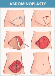 diagram of an abdominoplasty