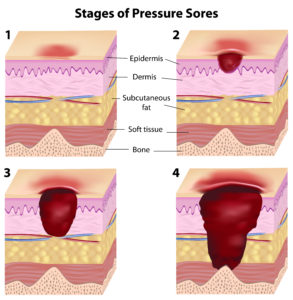 Stages of pressure sores