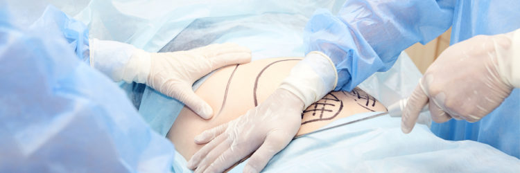 liposuction operation. Doctor hands near belly
