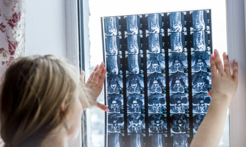 MRI of the back of the vertebral section, hernia in the intervertebrates close-up